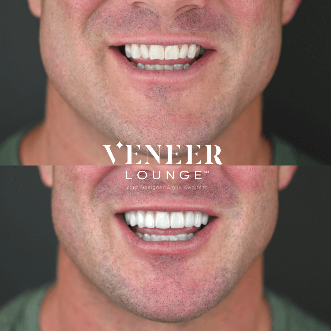 Veneer Transformation Austin TX — Veneer Lounge before and after