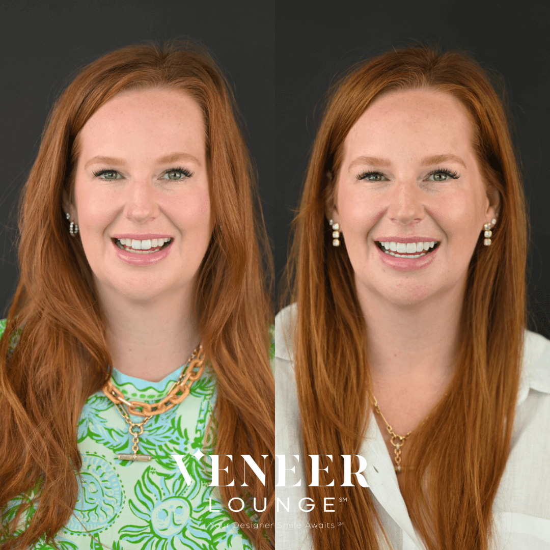 Porcelain Veneers Austin TX — Veneer Lounge before and after