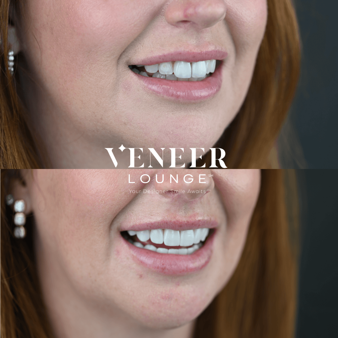 Full Set Veneers Austin TX — Veneer Lounge before and after