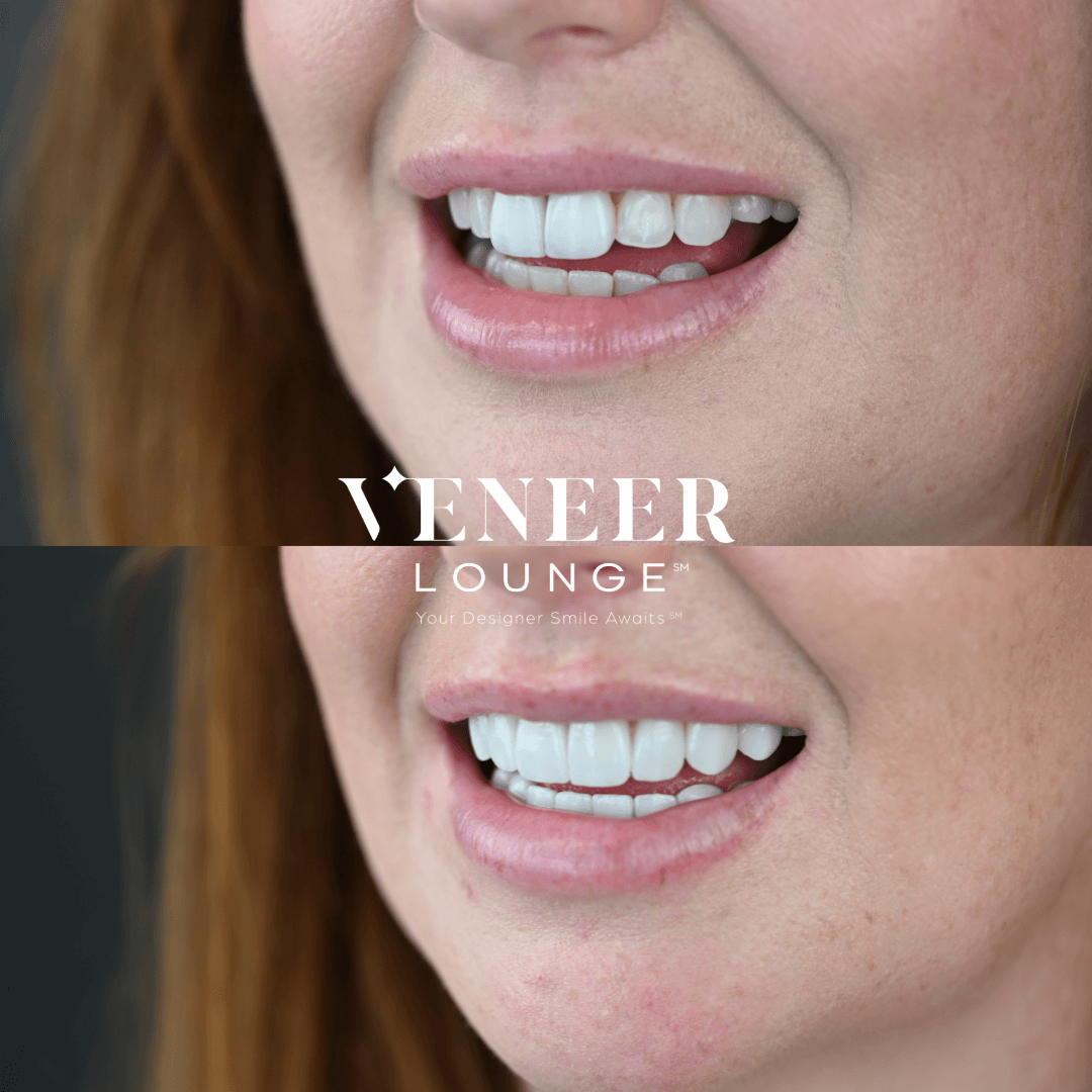 Smile Makeover Austin TX — Veneer Lounge before and after