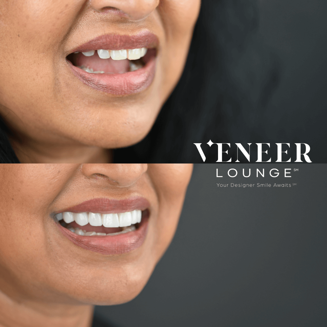 Veneer Results Austin TX — Veneer Lounge before and after