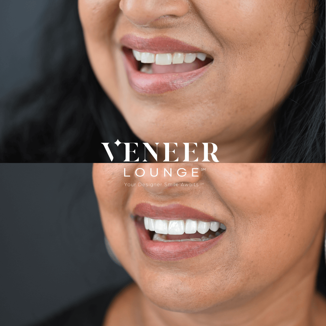 Porcelain Veneers Austin TX — Veneer Lounge before and after