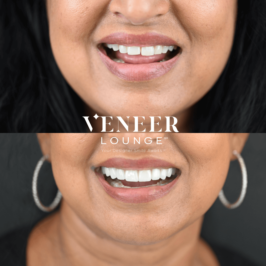 Austin Smile Makeover Austin TX — Veneer Lounge before and after