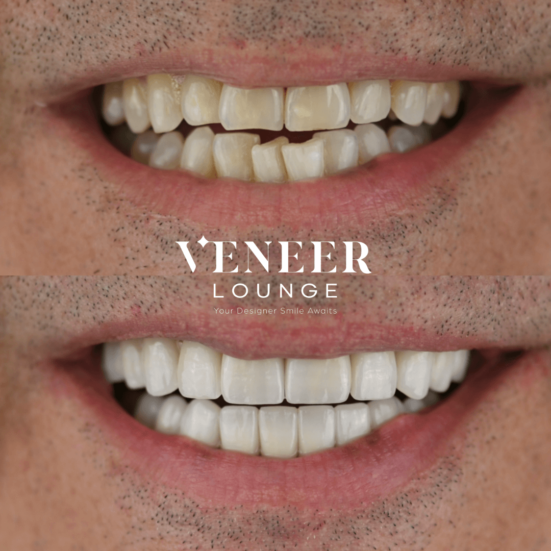 Smile Design Austin TX — Veneer Lounge before and after