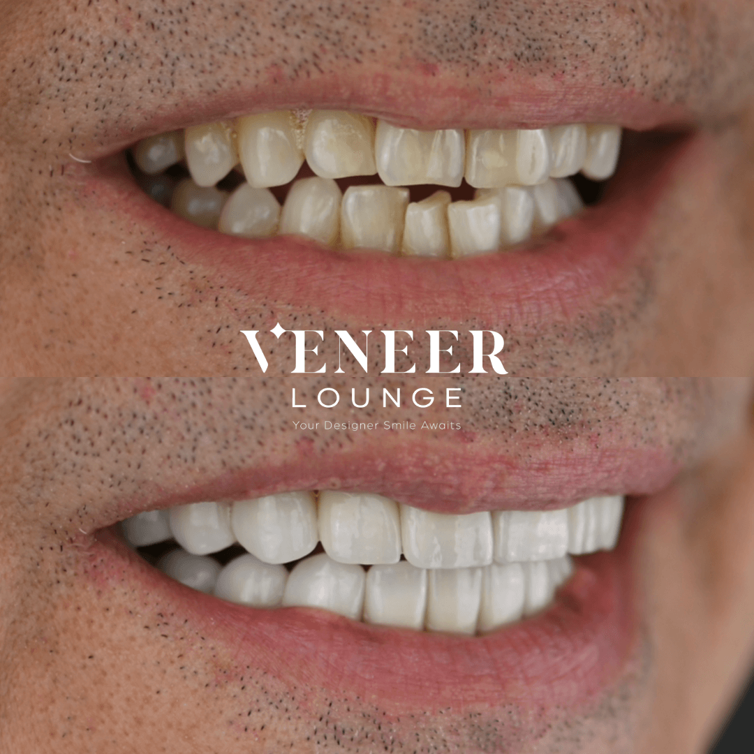 Cosmetic Veneers Austin TX — Veneer Lounge before and after
